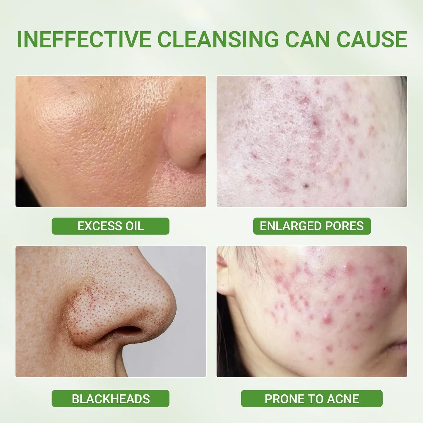 ✨ 3X Acid Deep Pores Cleansing Clay Mask - Unclog & Purify