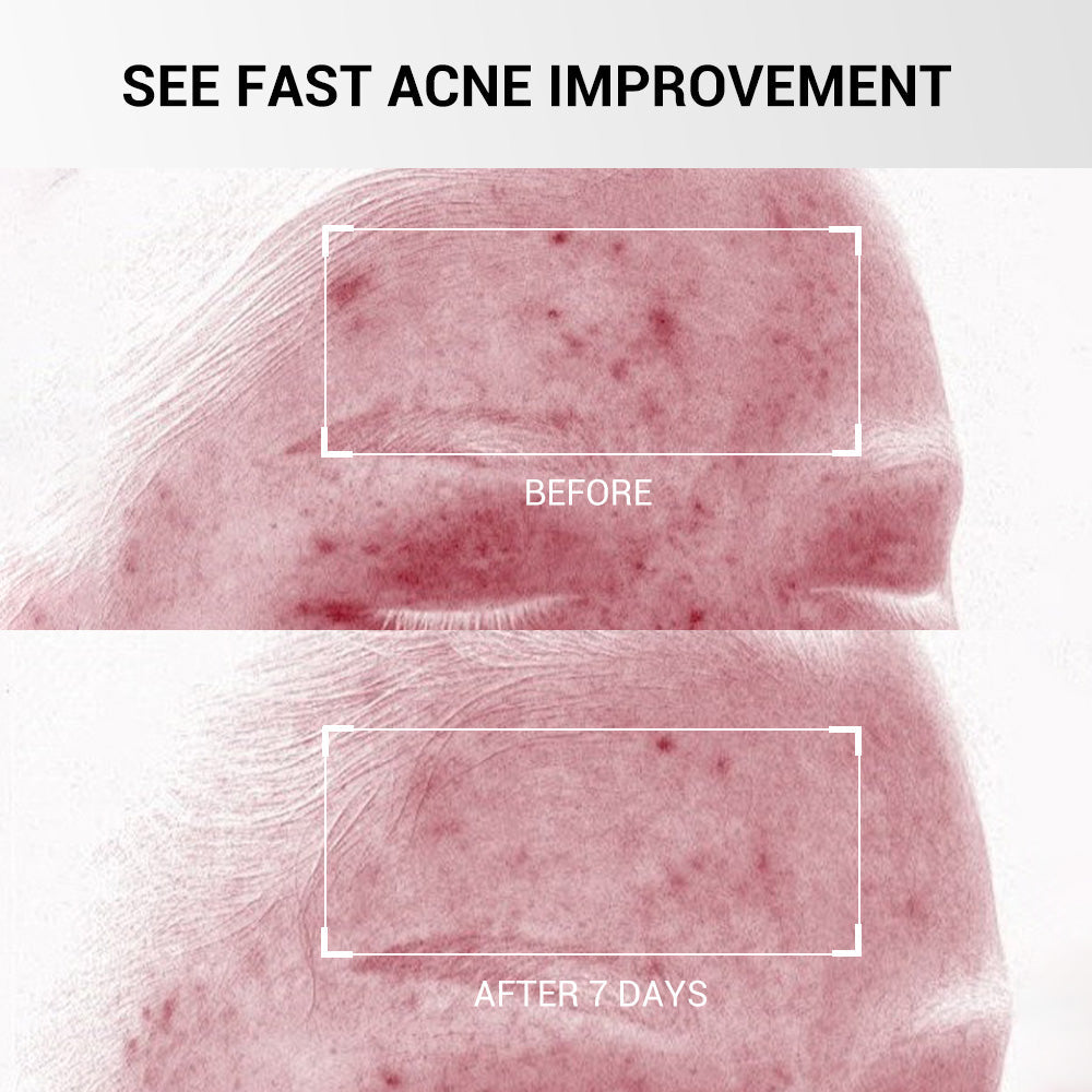 🌸Overnight Acne Spot Treatment - 10% Sulfur & Salicylic Acid (20mL)🌿