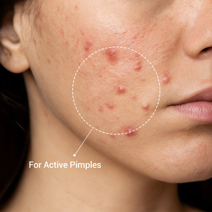 🌸Overnight Acne Spot Treatment - 10% Sulfur & Salicylic Acid (20mL)🌿