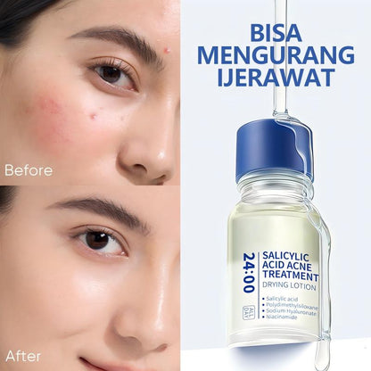🌸Overnight Acne Spot Treatment - 10% Sulfur & Salicylic Acid (20mL)🌿